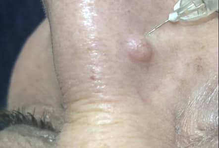 Benign Skin Lesions Removal