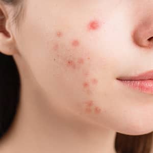 Acne Skin Condition