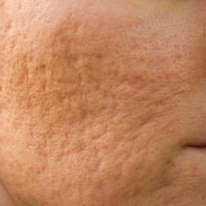 Acne Scarring Skin Condition
