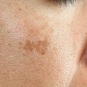 Age Spots Skin Condition