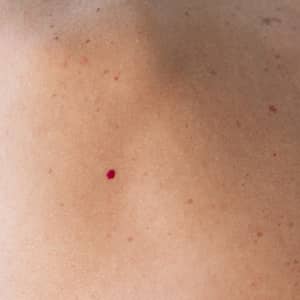 Cherry Angioma Skin Condition