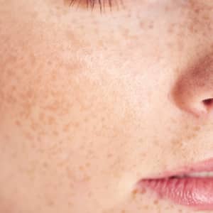 Freckles Skin Condition