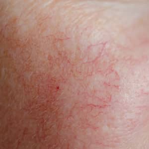 Spider Naevi Skin Condition
