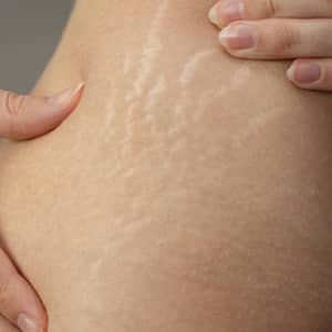 Stretch Marks Skin Condition
