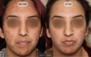 Acne & Pigmentation Before & After Photo