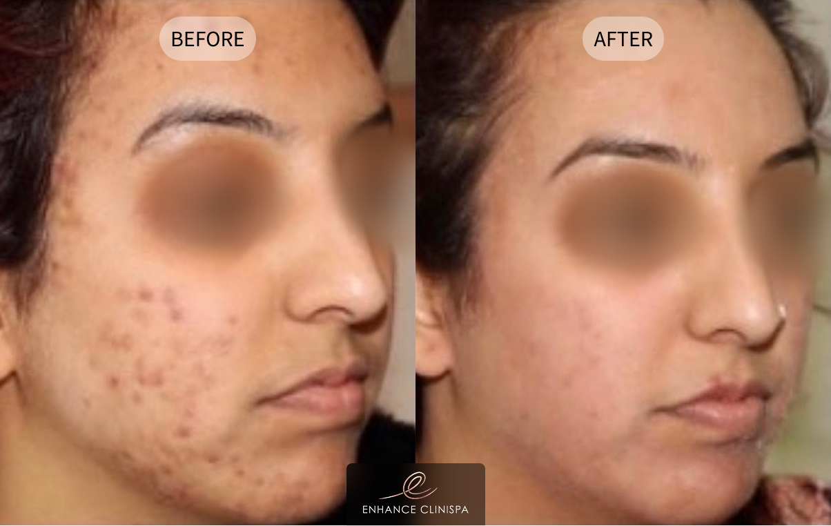 Acne & Pigmentation Before & After Photo